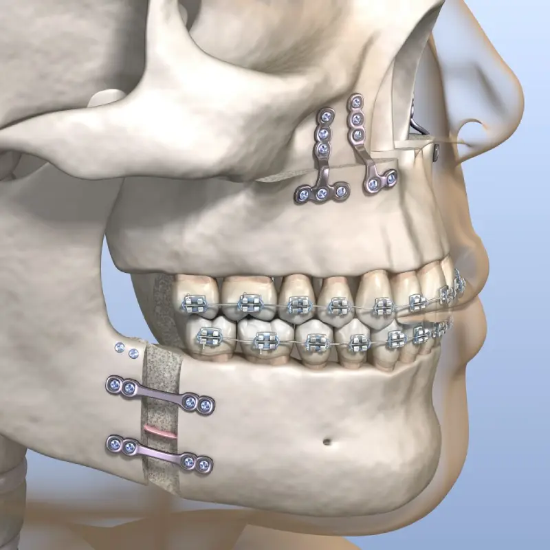 Oral surgery
