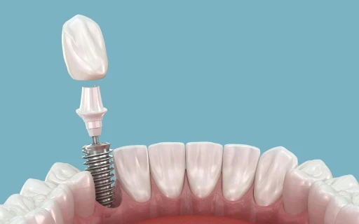New implant technology